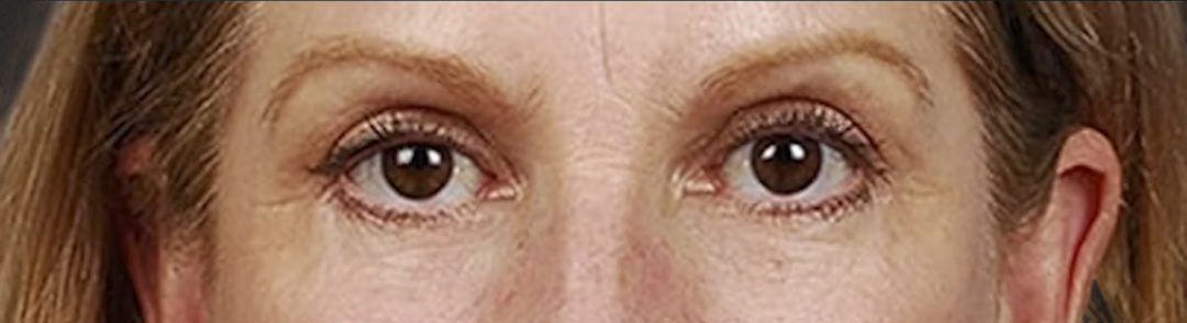 Blepharoplasty Before & After Gallery - Patient 177584 - Image 2