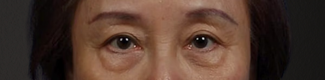 Blepharoplasty Before & After Gallery - Patient 181630 - Image 1