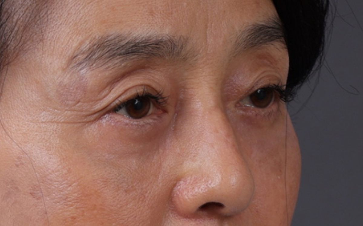 Blepharoplasty Before & After Gallery - Patient 189111 - Image 4