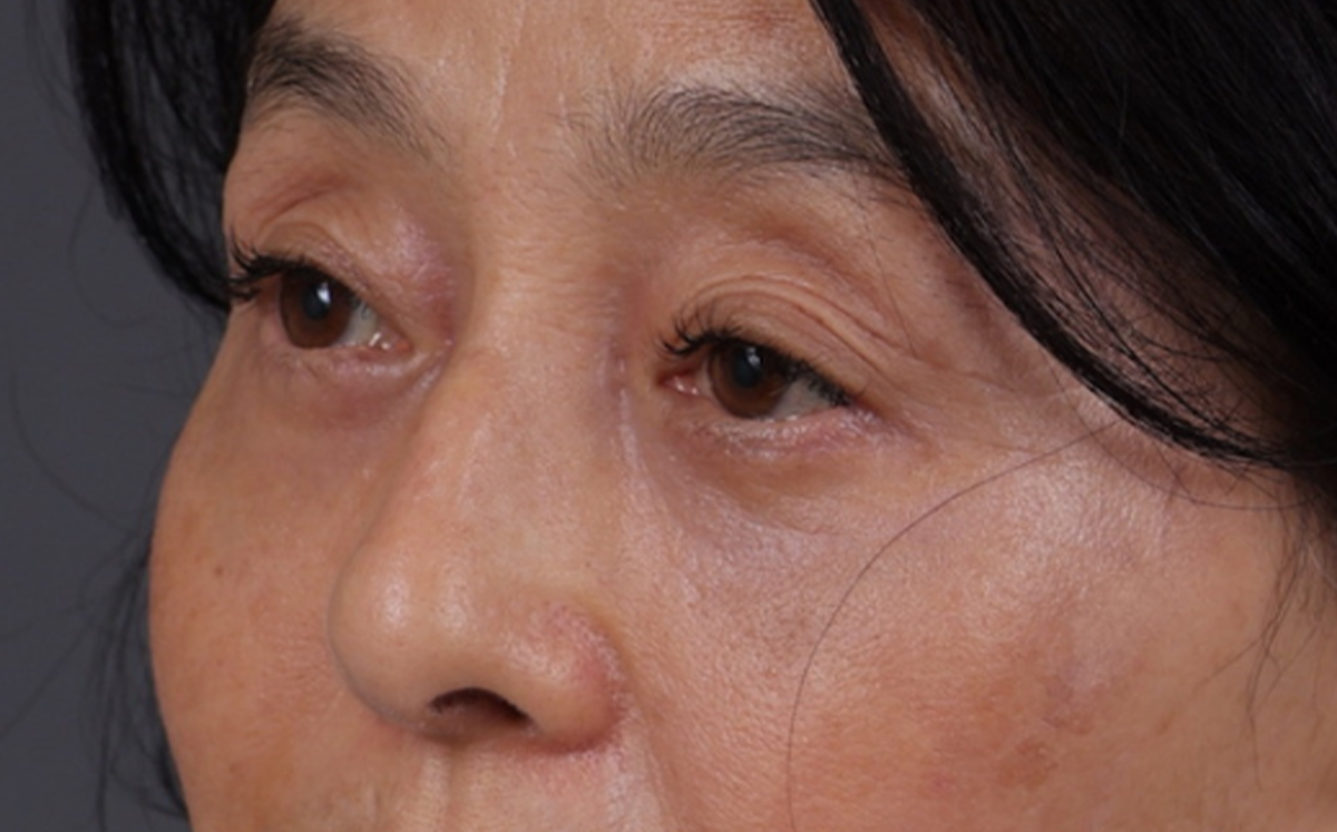Blepharoplasty Before & After Gallery - Patient 189111 - Image 2