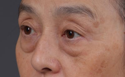 Blepharoplasty Before & After Gallery - Patient 189111 - Image 1