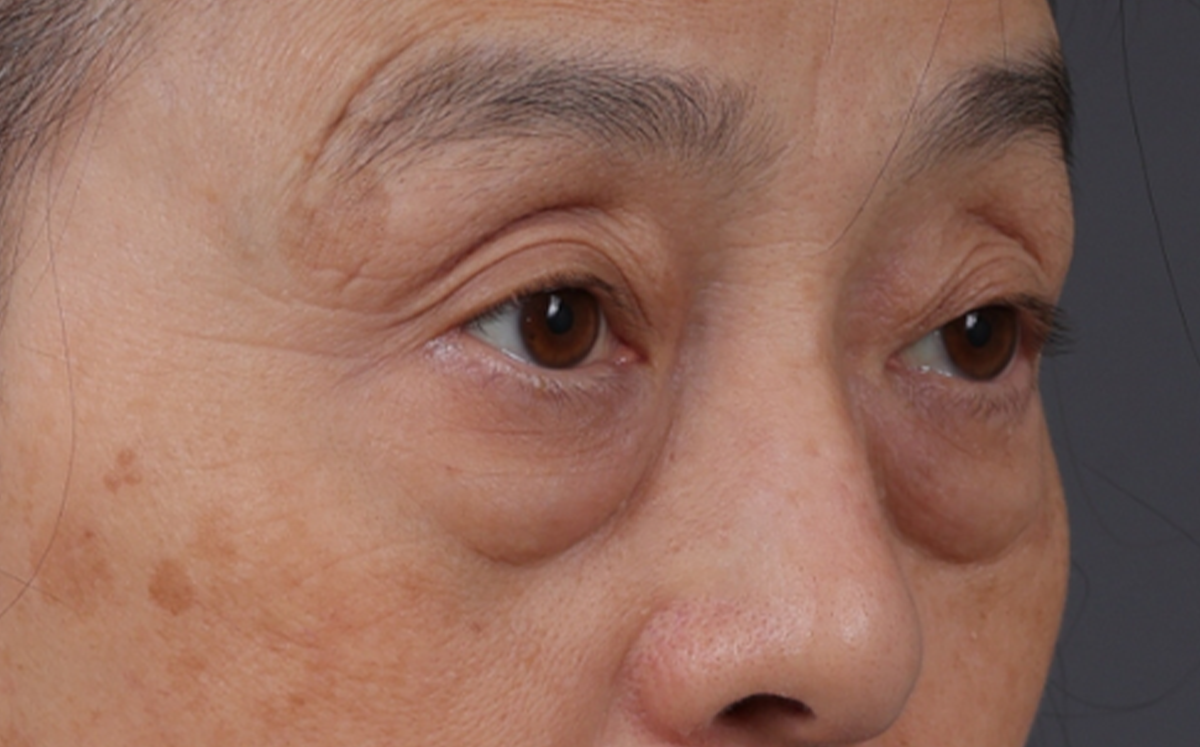 Blepharoplasty Before & After Gallery - Patient 189111 - Image 3