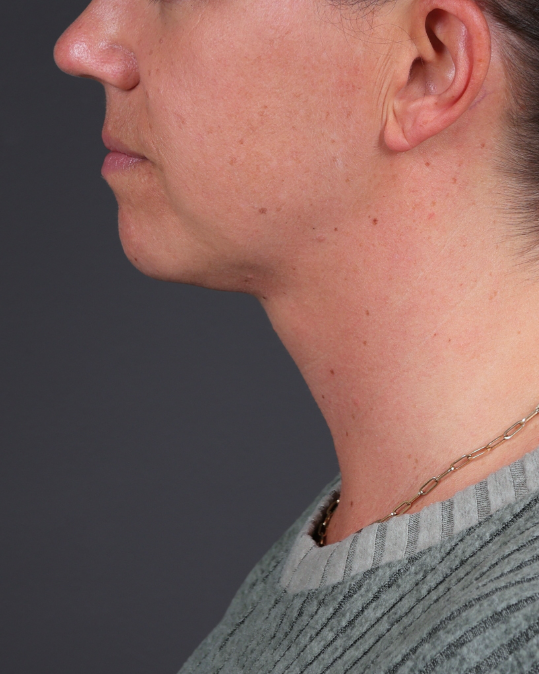 Neck Lift Before & After Gallery - Patient 261911 - Image 4