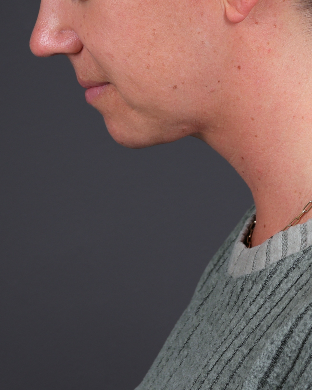 Neck Lift Before & After Gallery - Patient 261911 - Image 2