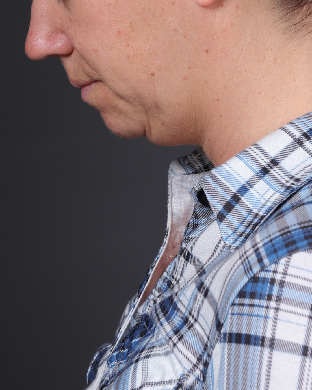 Neck Lift Before & After Gallery - Patient 261911 - Image 1