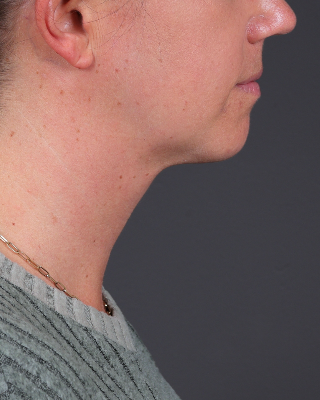 Neck Lift Before & After Gallery - Patient 261911 - Image 8