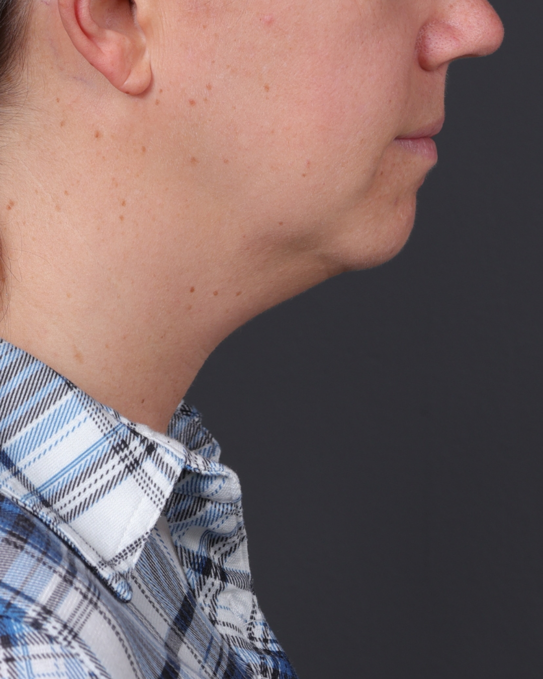 Neck Lift Before & After Gallery - Patient 261911 - Image 7