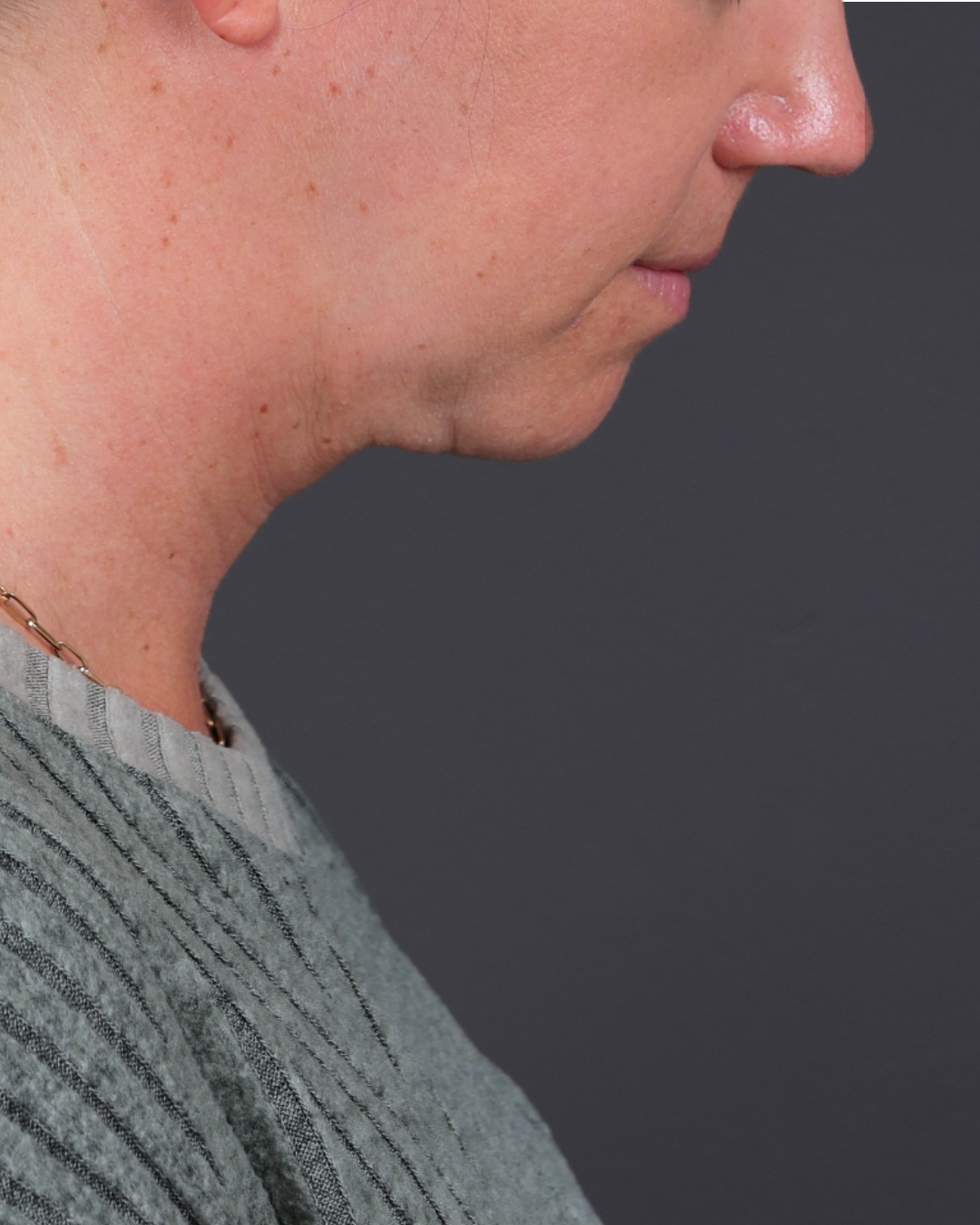 Neck Lift Before & After Gallery - Patient 261911 - Image 6