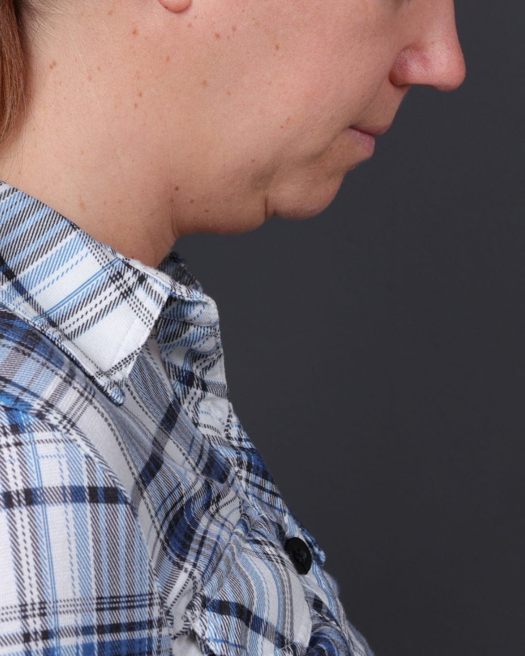 Neck Lift Before & After Gallery - Patient 261911 - Image 5