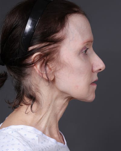 Facelift Before & After Gallery - Patient 681791 - Image 1