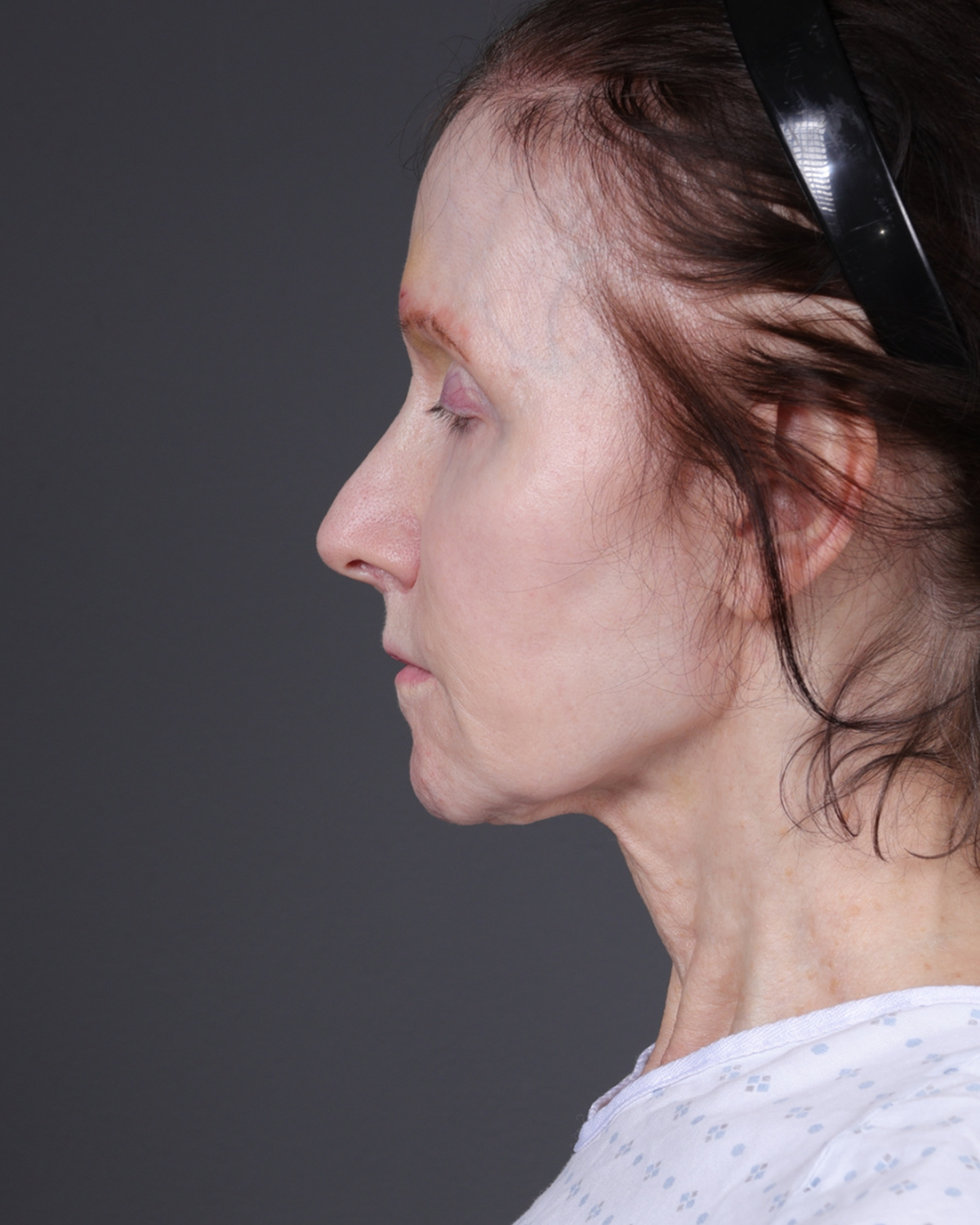 Neck Lift Before & After Gallery - Patient 281882 - Image 3