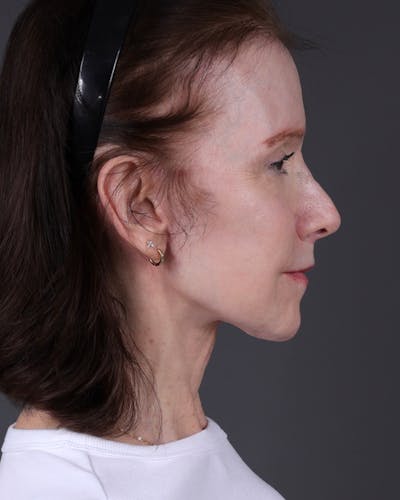 Facelift Before & After Gallery - Patient 681791 - Image 2