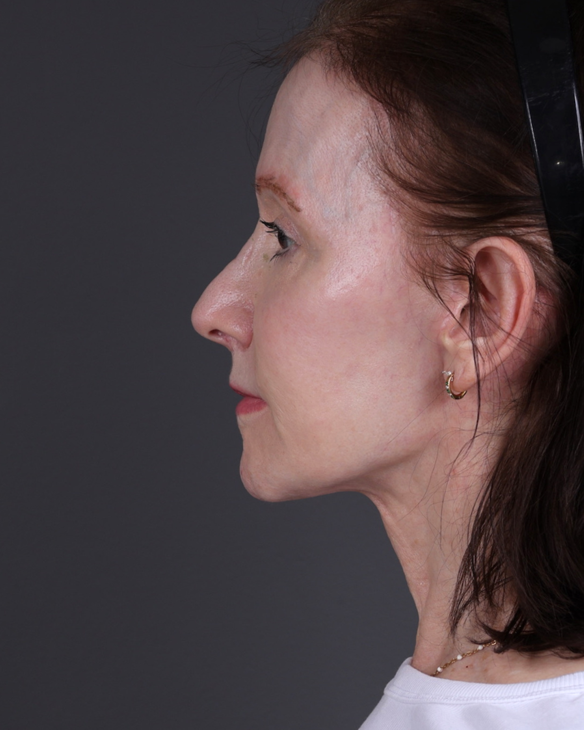 Neck Lift Before & After Gallery - Patient 281882 - Image 4