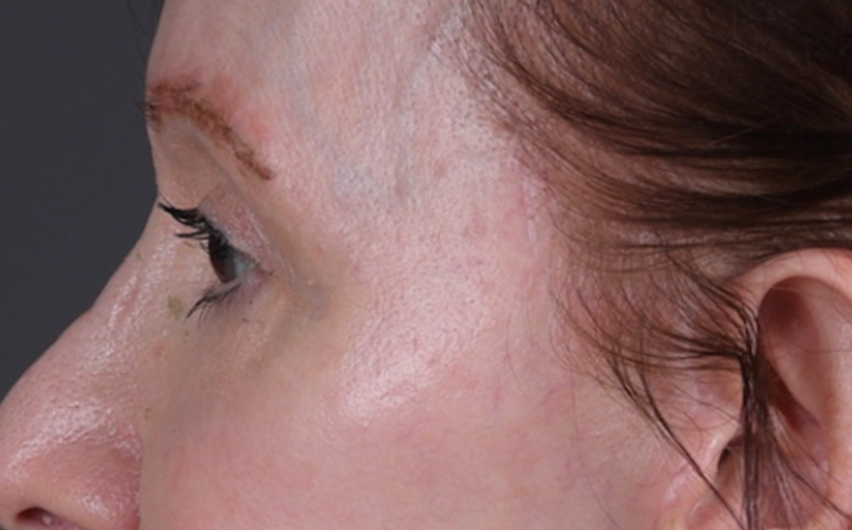 Brow Lift Before & After Gallery - Patient 147613 - Image 4