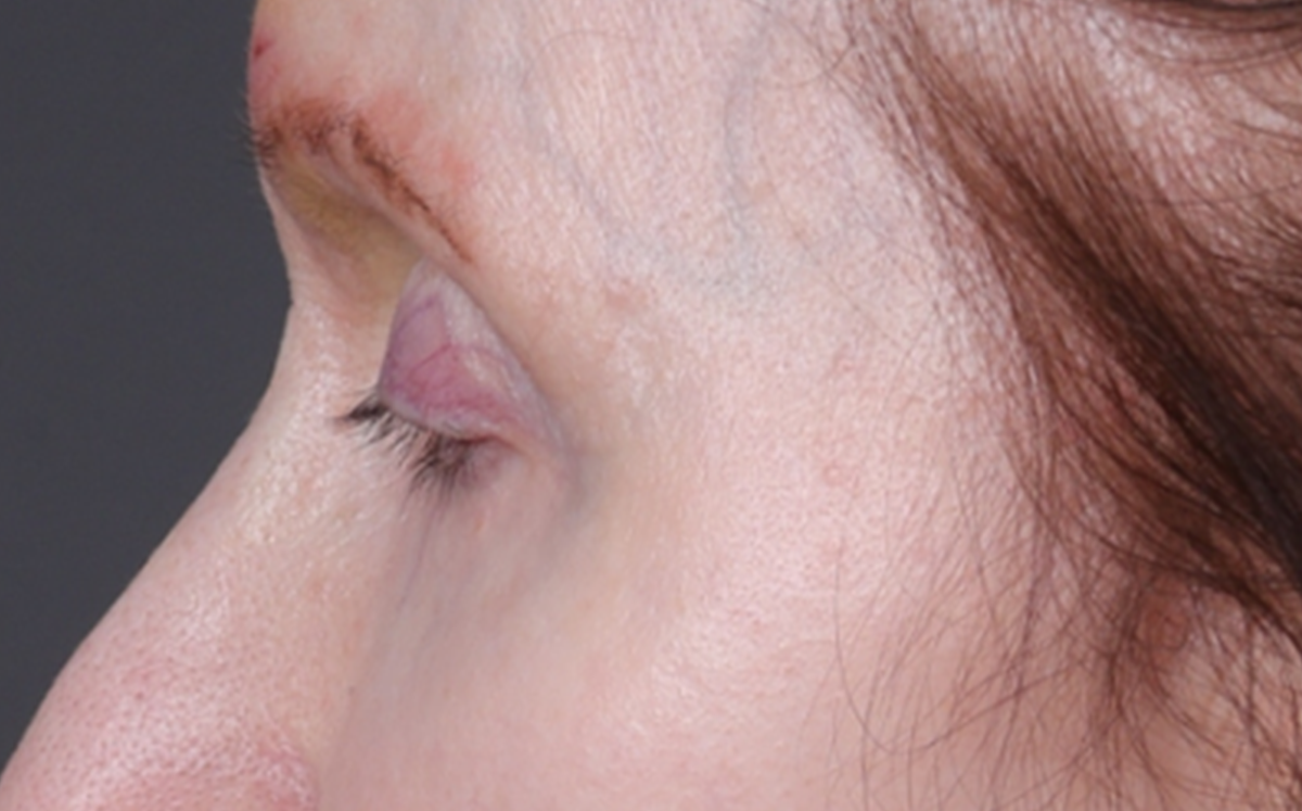 Brow Lift Before & After Gallery - Patient 147613 - Image 3