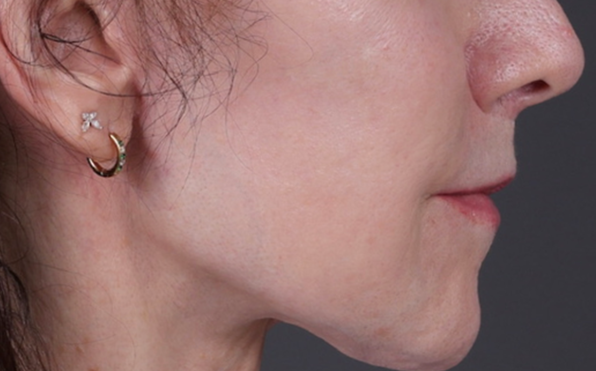 Lip Lift Before & After Gallery - Patient 181972 - Image 2
