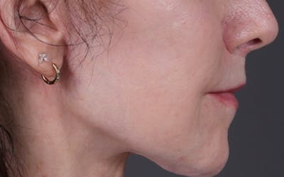 Lip Lift Before & After Gallery - Patient 181972 - Image 2