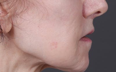 Lip Lift Before & After Gallery - Patient 181972 - Image 1