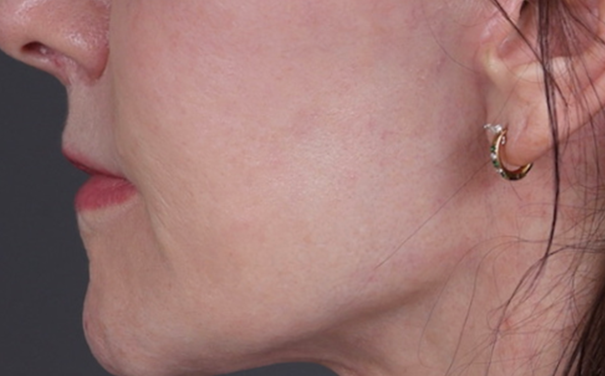 Lip Lift Before & After Gallery - Patient 181972 - Image 4