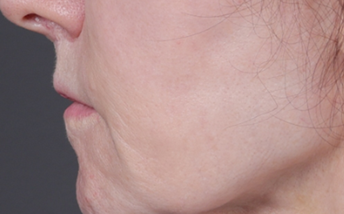 Lip Lift Before & After Gallery - Patient 181972 - Image 3