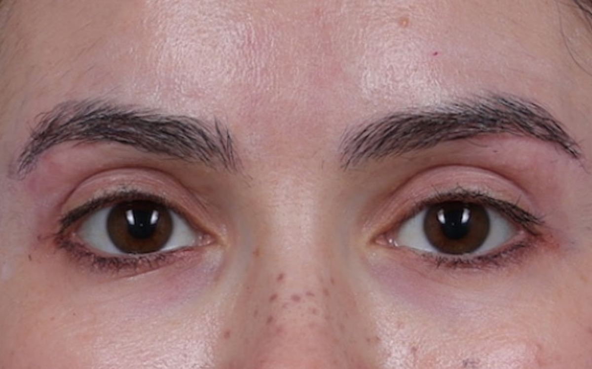 Brow Lift Before & After Gallery - Patient 195460 - Image 2