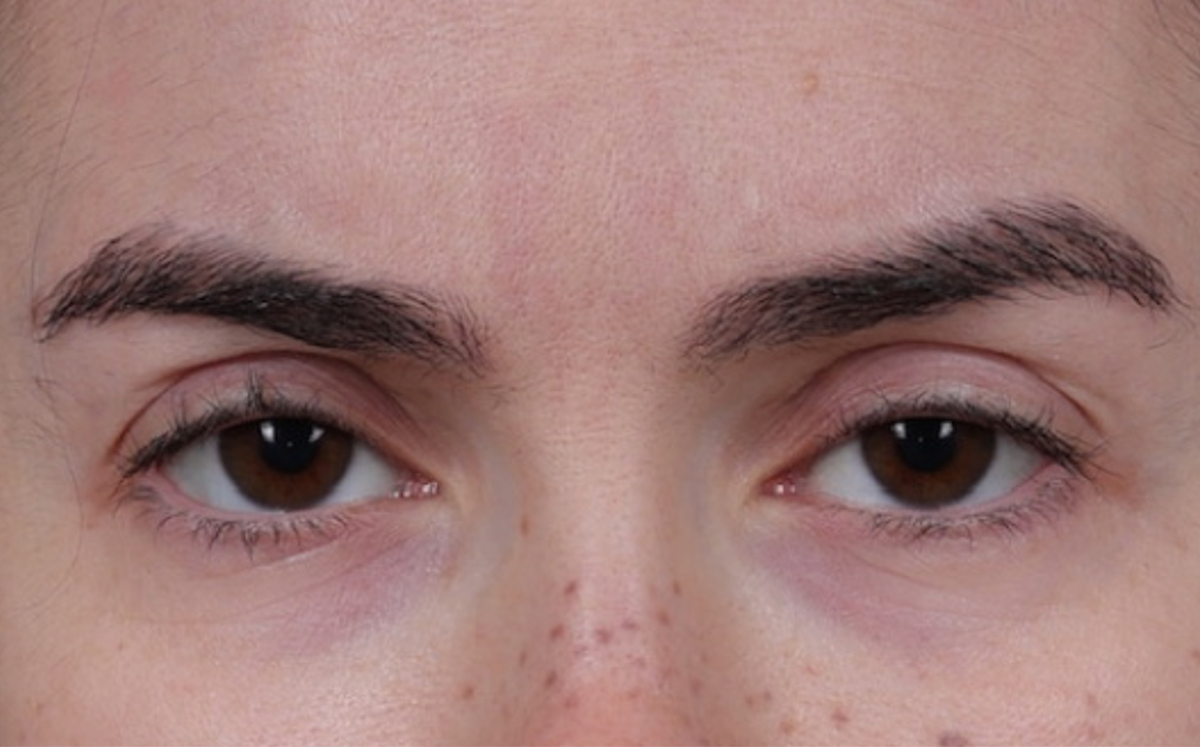 Brow Lift Before & After Gallery - Patient 195460 - Image 1