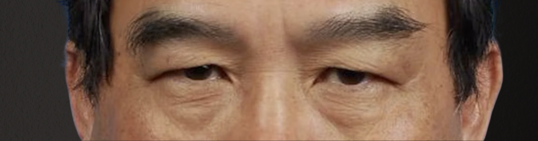 Blepharoplasty Before & After Gallery - Patient 232957 - Image 1