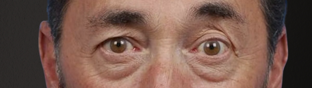 Blepharoplasty Before & After Gallery - Patient 289939 - Image 1