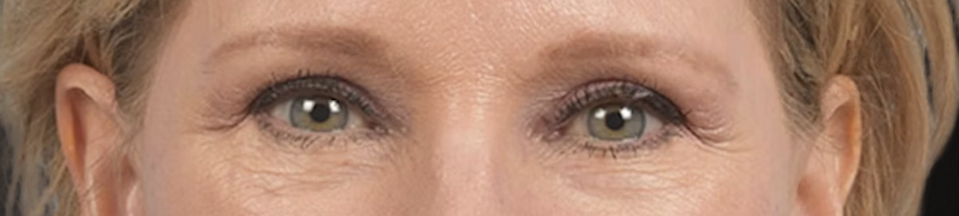 Blepharoplasty Before & After Gallery - Patient 216006 - Image 2