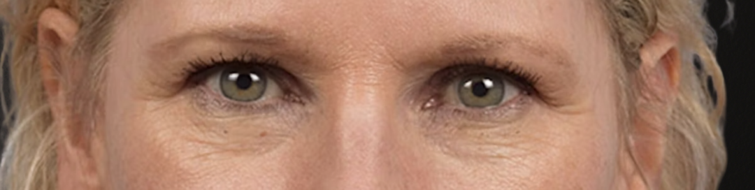 Blepharoplasty Before & After Gallery - Patient 216006 - Image 1