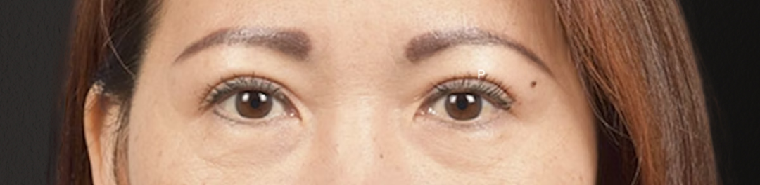 Blepharoplasty Before & After Gallery - Patient 252264 - Image 2