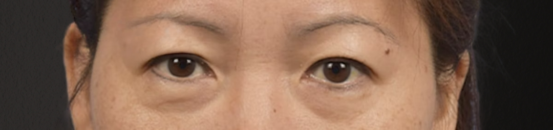 Blepharoplasty Before & After Gallery - Patient 252264 - Image 1