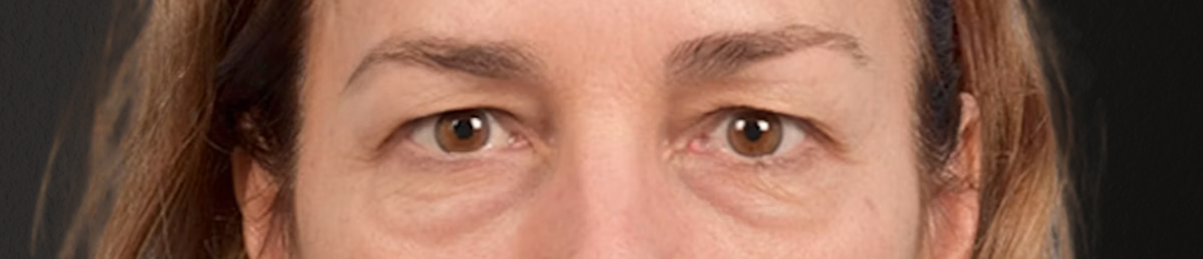 Blepharoplasty Before & After Gallery - Patient 195497 - Image 1