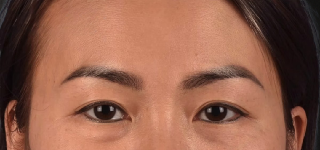 Blepharoplasty Before & After Gallery - Patient 301798 - Image 1