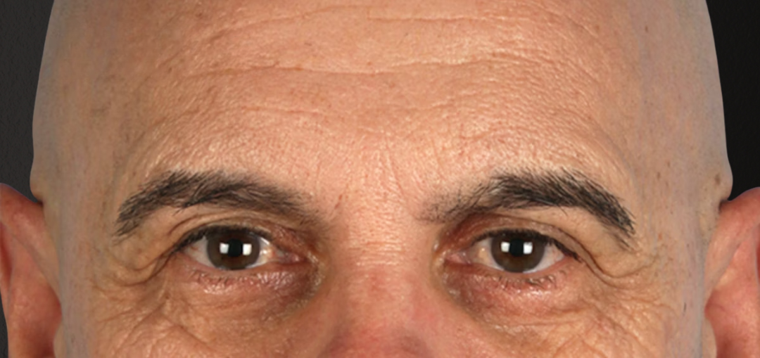 Blepharoplasty Before & After Gallery - Patient 309869 - Image 1