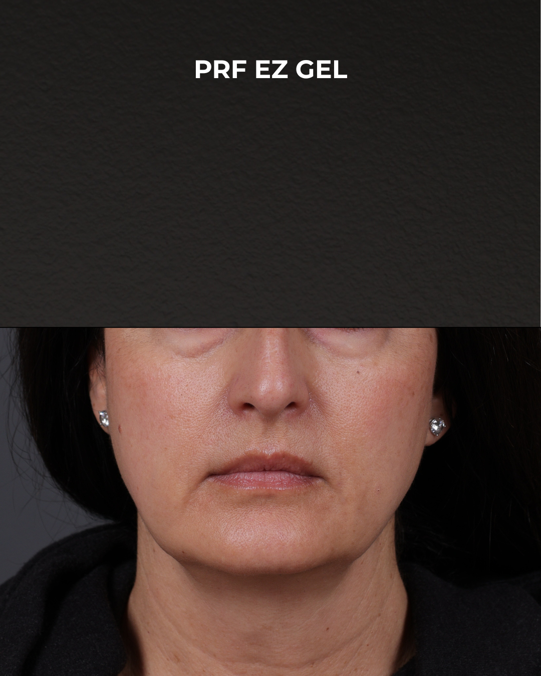 Dermal Fillers Before & After Gallery - Patient 186879 - Image 1