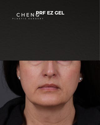 Dermal Fillers Before & After Gallery - Patient 186879 - Image 1