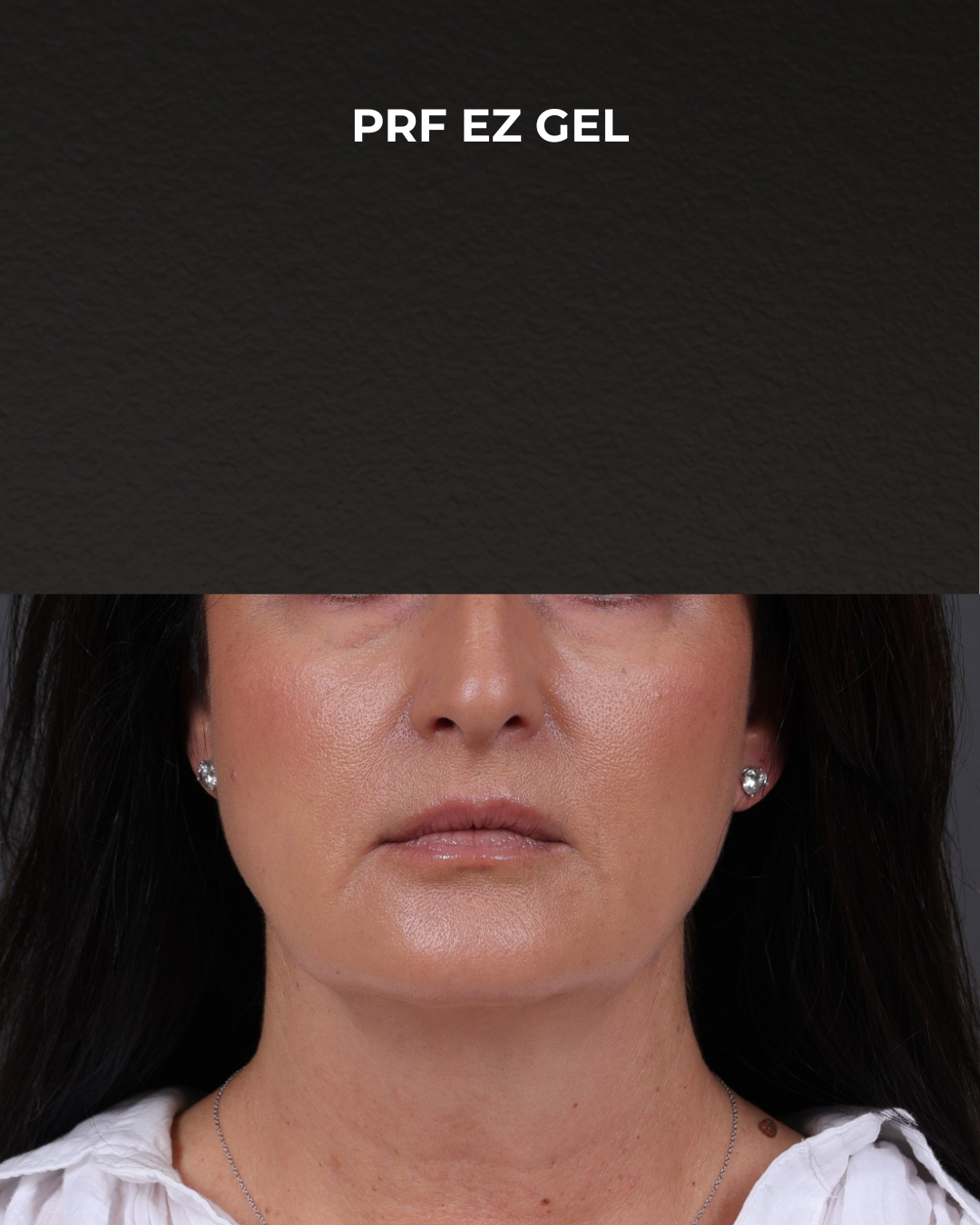 Dermal Fillers Before & After Gallery - Patient 186879 - Image 2