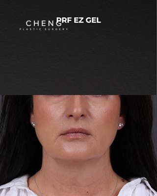 Dermal Fillers Before & After Gallery - Patient 186879 - Image 2