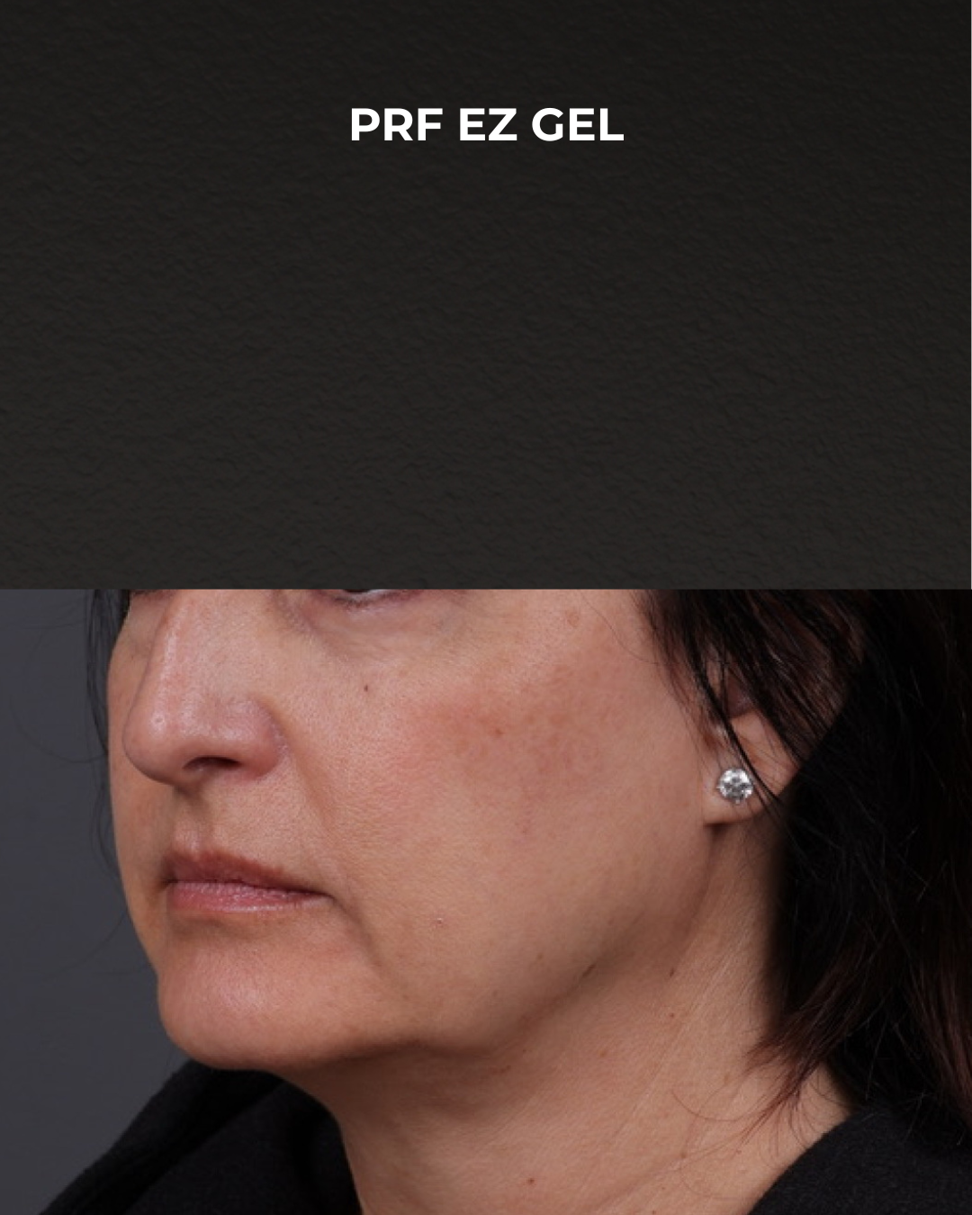 Dermal Fillers Before & After Gallery - Patient 186879 - Image 3