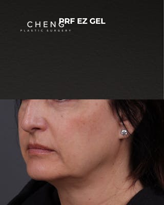 Dermal Fillers Before & After Gallery - Patient 186879 - Image 3