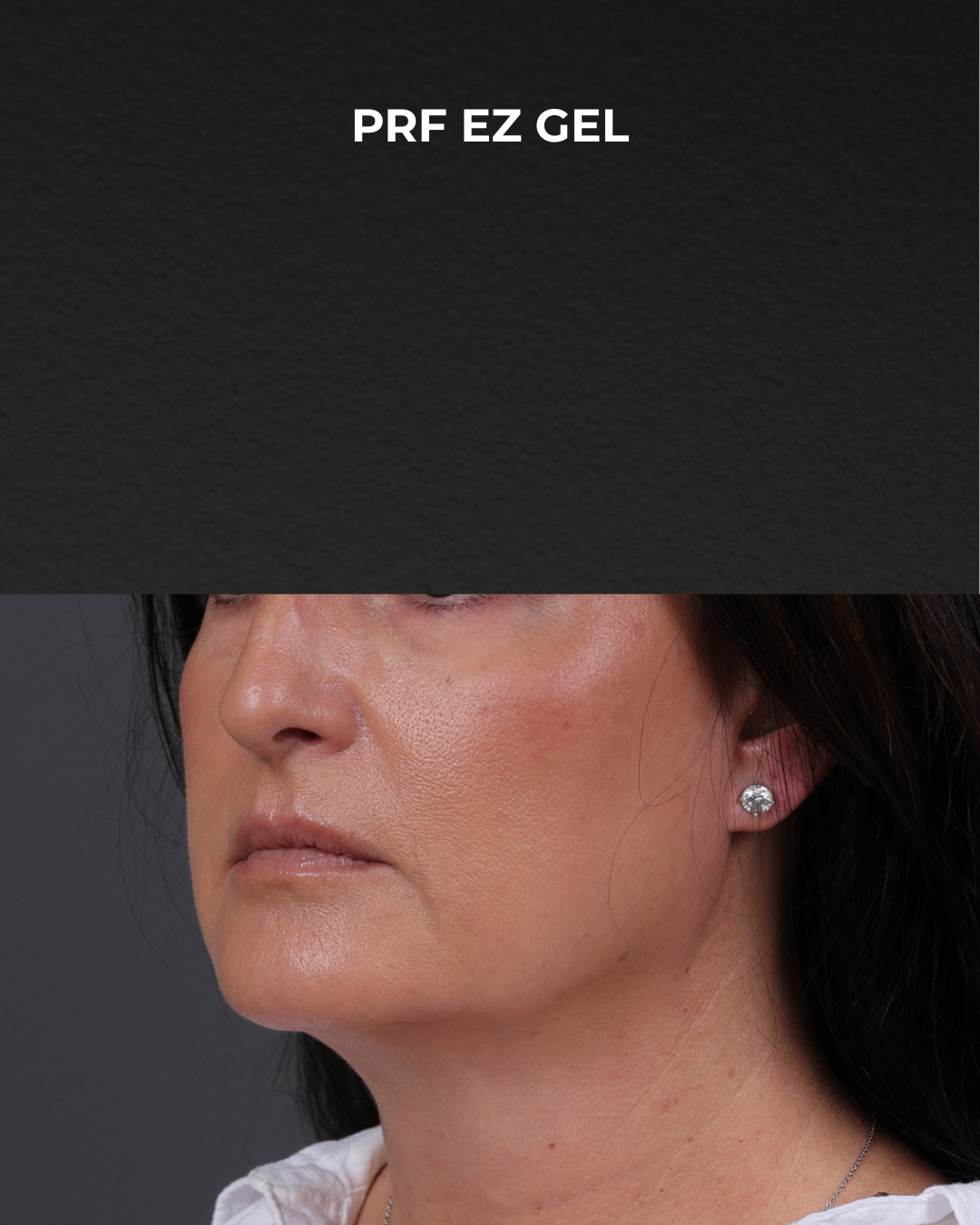 Dermal Fillers Before & After Gallery - Patient 186879 - Image 4