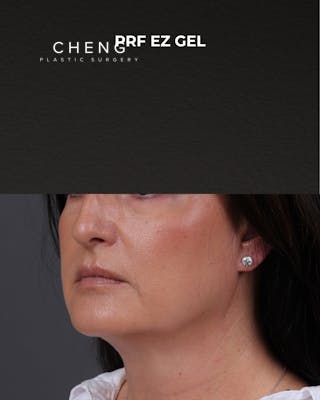 Dermal Fillers Before & After Gallery - Patient 186879 - Image 4