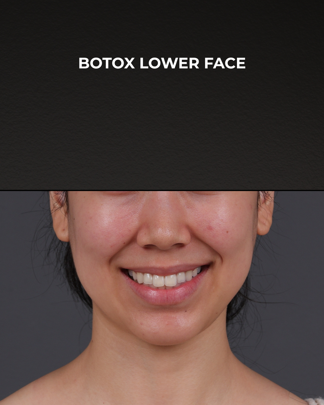 Botox and Dysport Before & After Gallery - Patient 326035 - Image 1