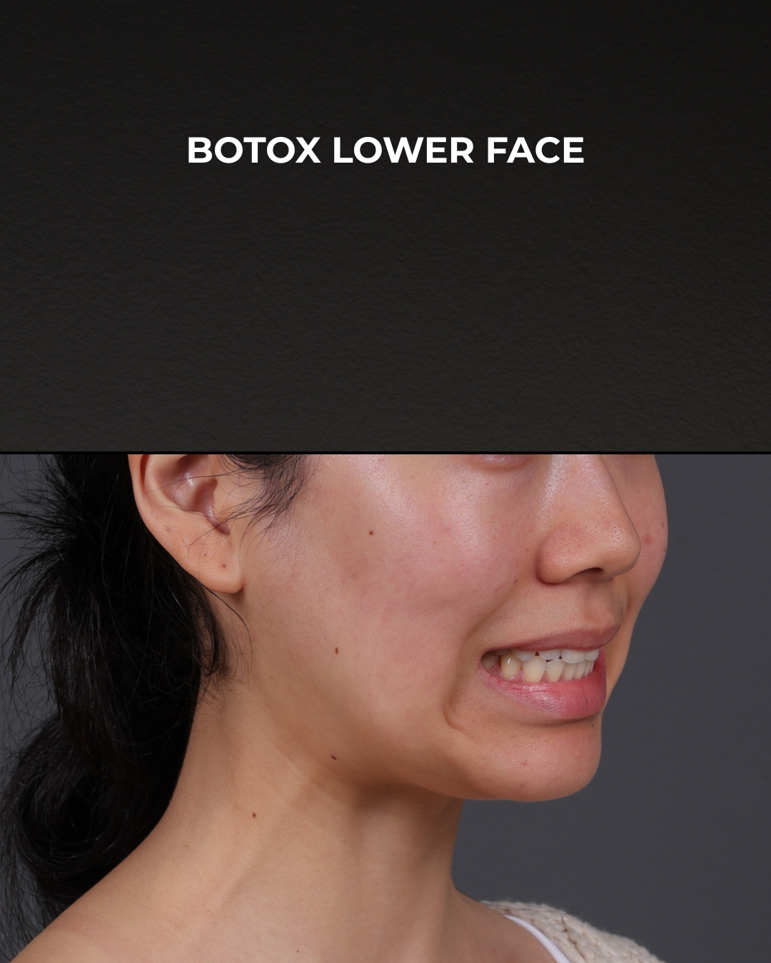 Botox and Dysport Before & After Gallery - Patient 326035 - Image 3