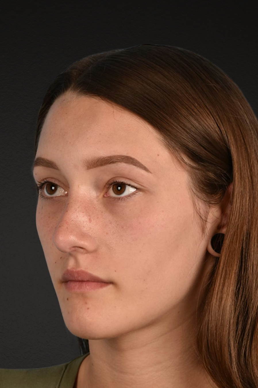 Rhinoplasty Before & After Gallery - Patient 399845 - Image 8