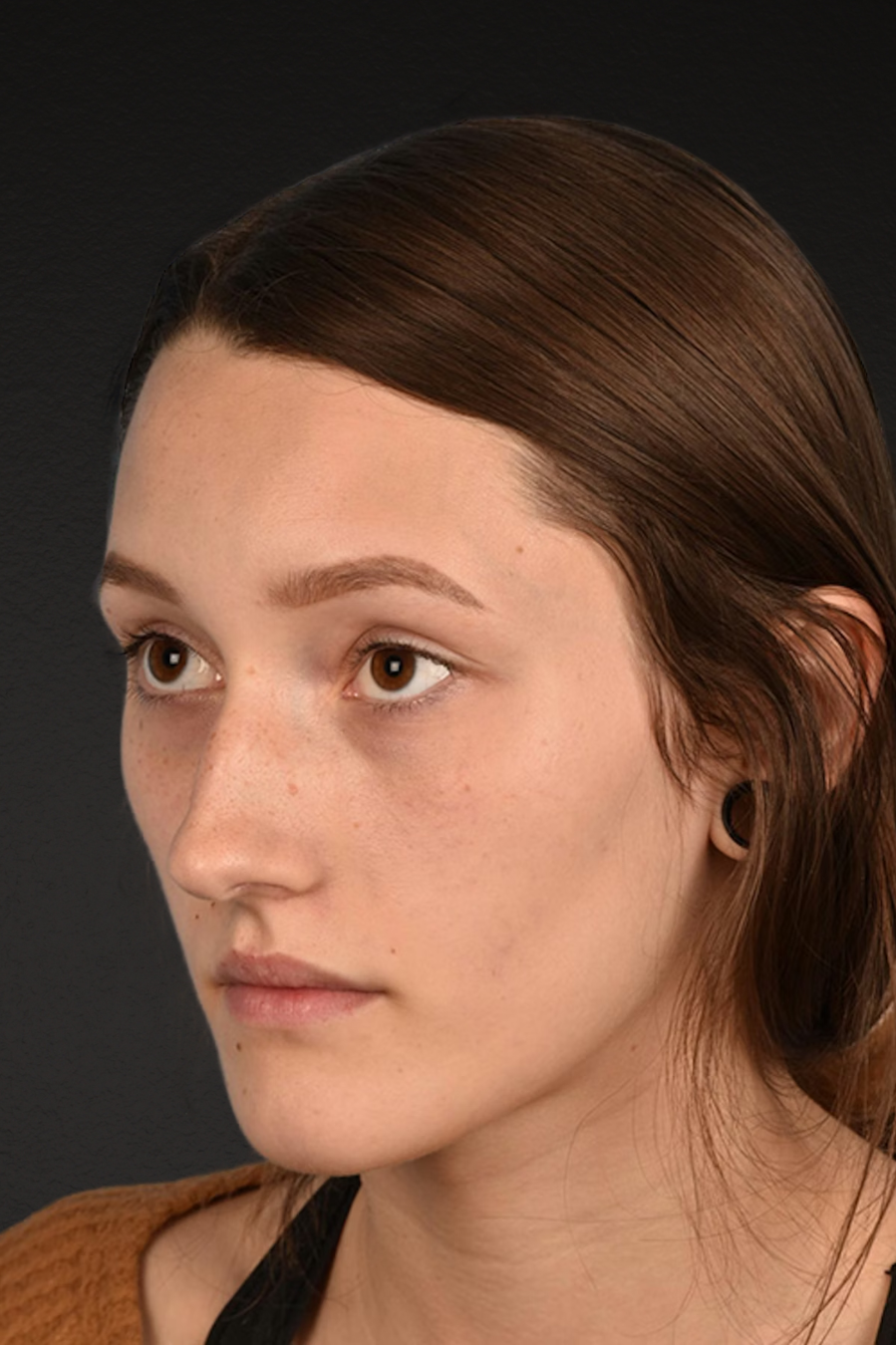 Rhinoplasty Before & After Gallery - Patient 399845 - Image 7