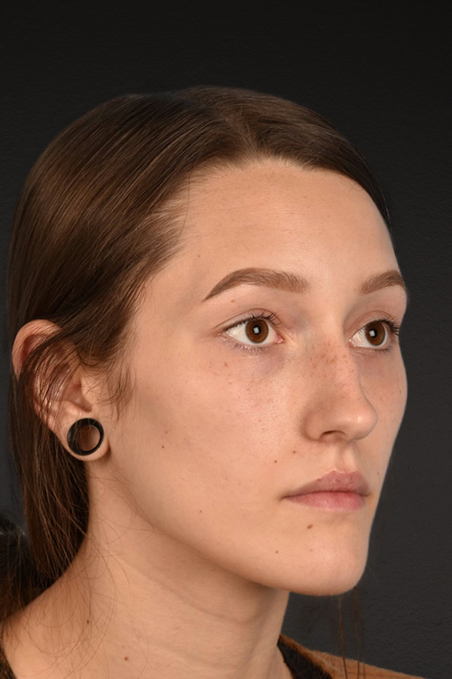 Rhinoplasty Before & After Gallery - Patient 399845 - Image 3
