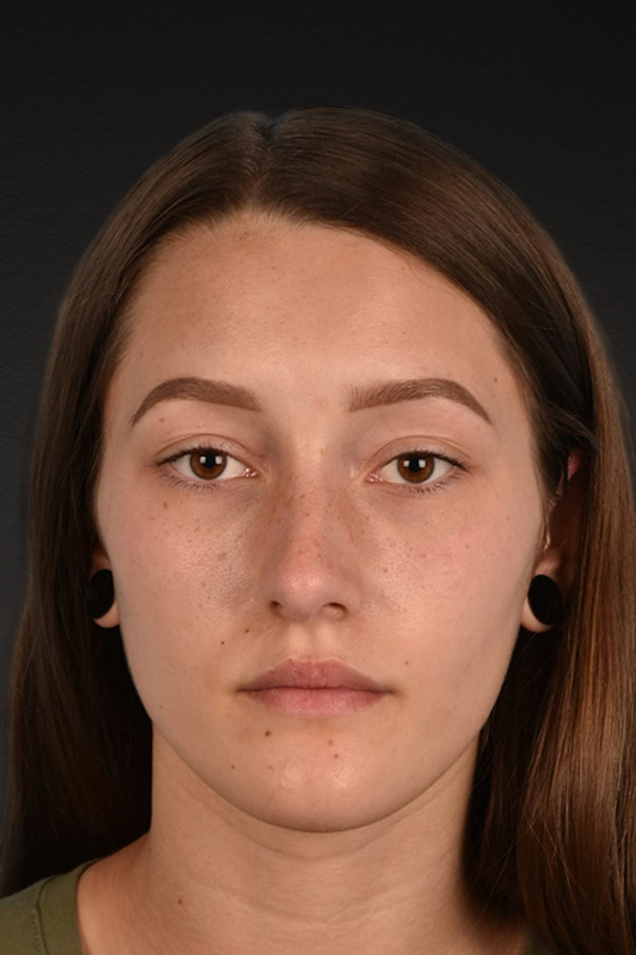 Rhinoplasty Before & After Gallery - Patient 399845 - Image 6