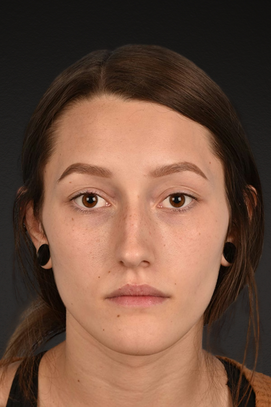 Rhinoplasty Before & After Gallery - Patient 399845 - Image 5